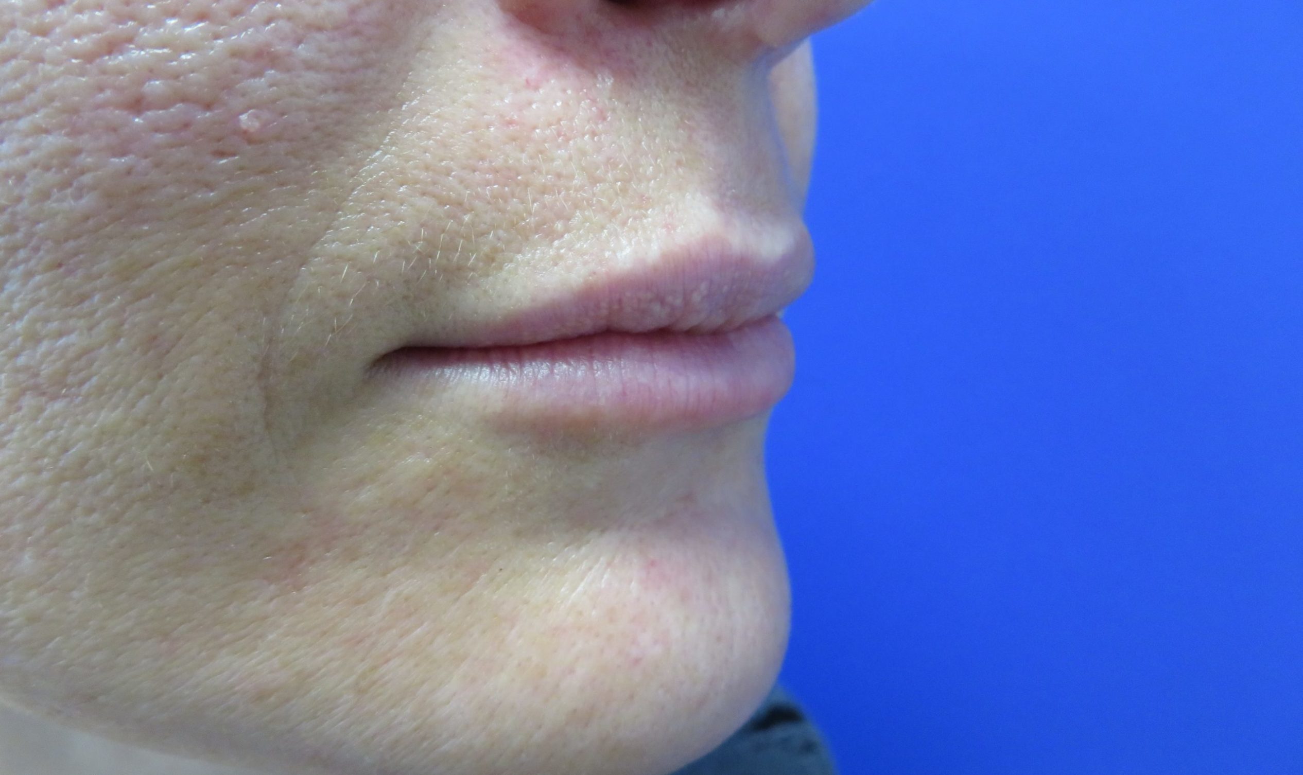 Injection d’Acide Hyaluronique - Dr Julien Genet, Chirurgien esthétique